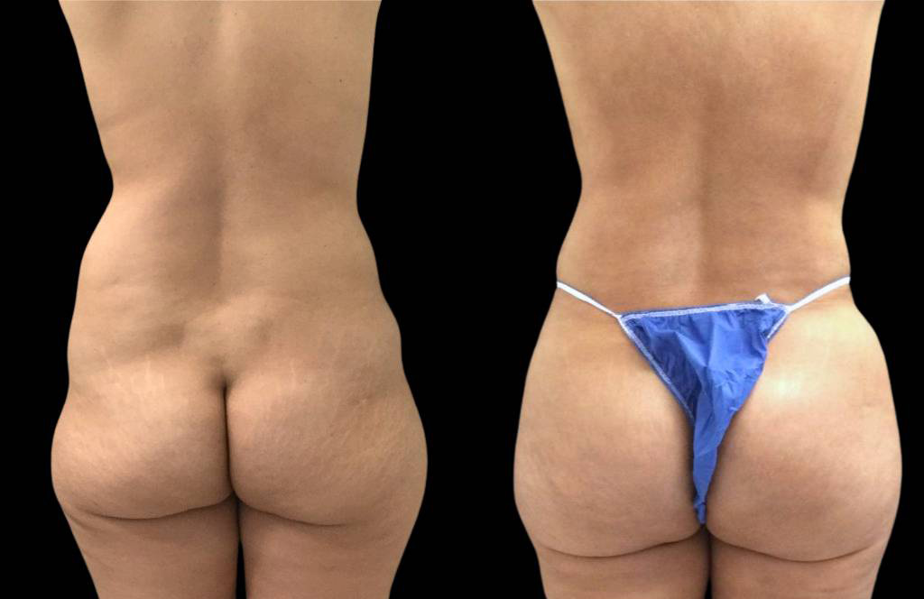This is a 48-year-old female that has had a brazilian butt lift showing the before and after's side-by-side