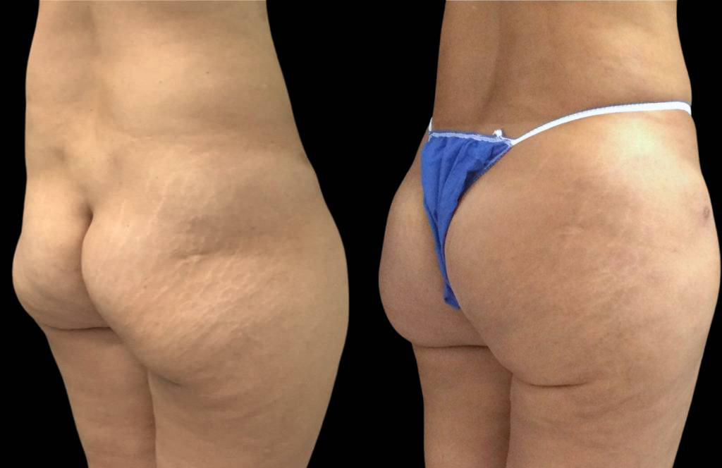 This is a 48-year-old female that has had a brazilian butt lift showing the before and after's side-by-side