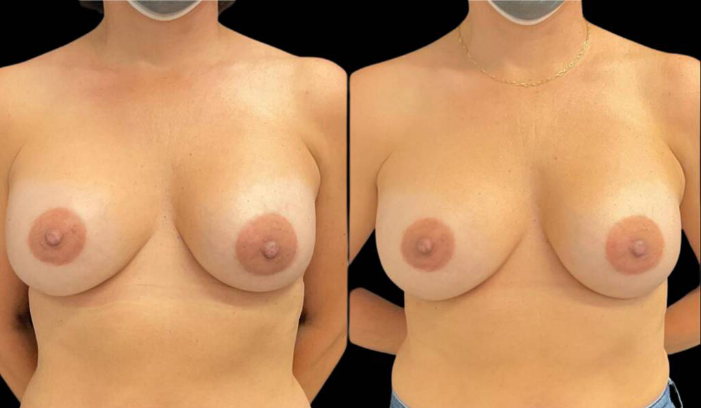 48-year-old-female-breast-implant-exchange-before-and-after-front-view-35284.jpg