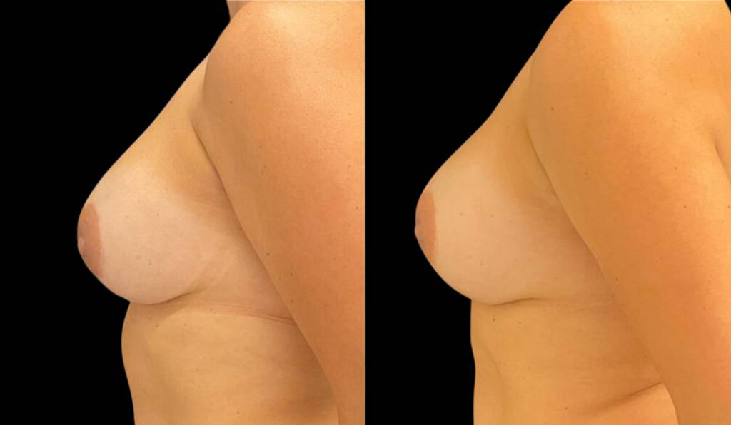 48-year-old-female-breast-implant-exchange-before-and-after-side-view.jpg