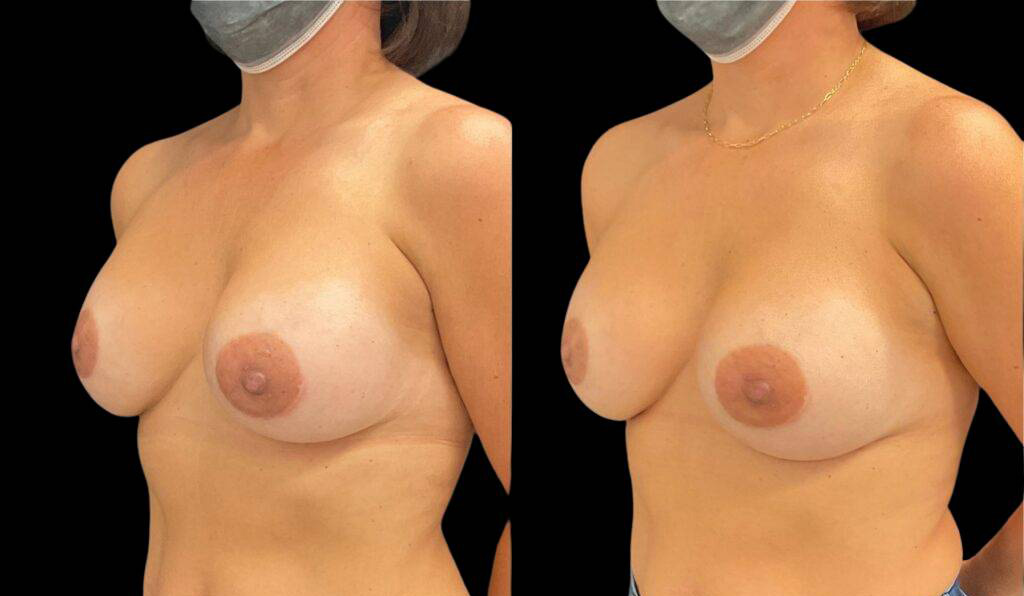 48-year-old-female-breast-implant-exchange-before-and-after-three-quarter-view-2.jpg