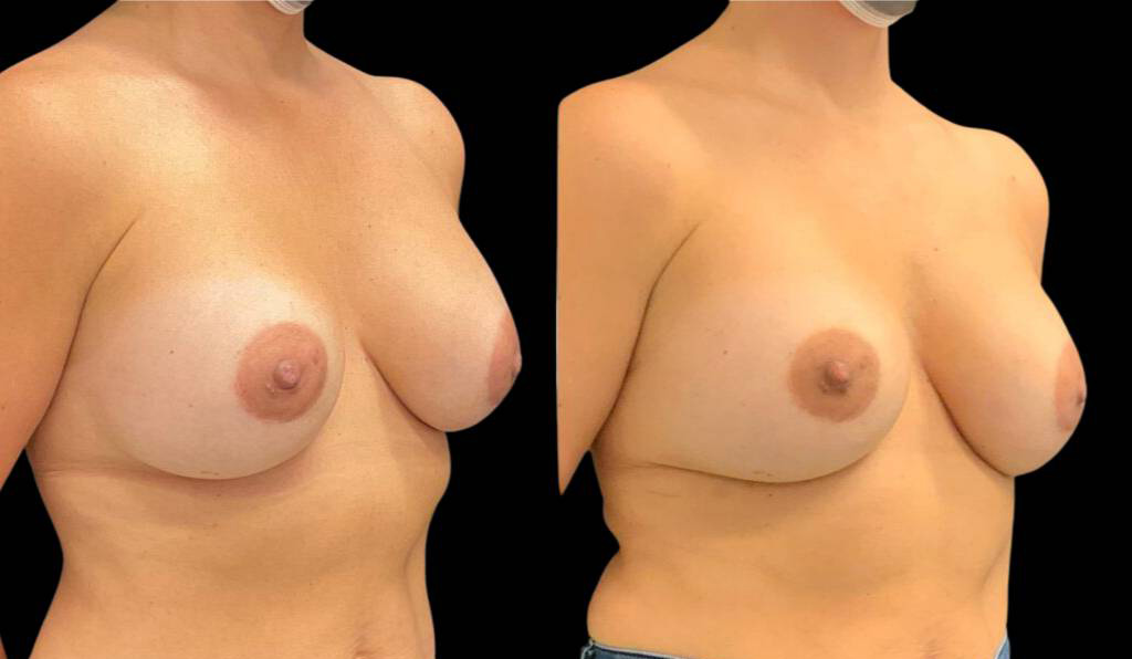 48-year-old-female-breast-implant-exchange-before-and-after-three-quarter-view.jpg