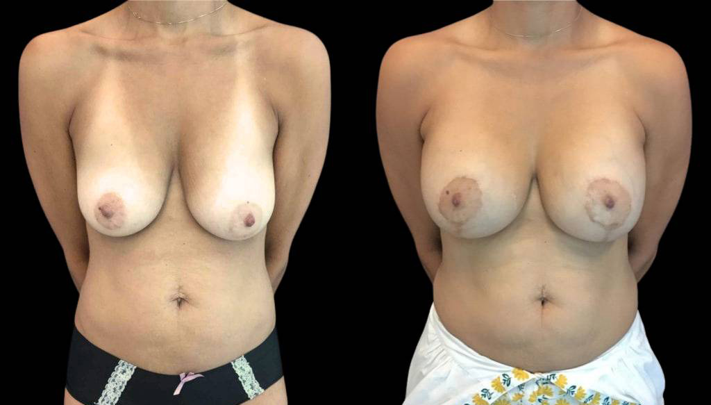 48-year-old-female-breast-lift-with-augmentation-before-and-after-front-view.jpg