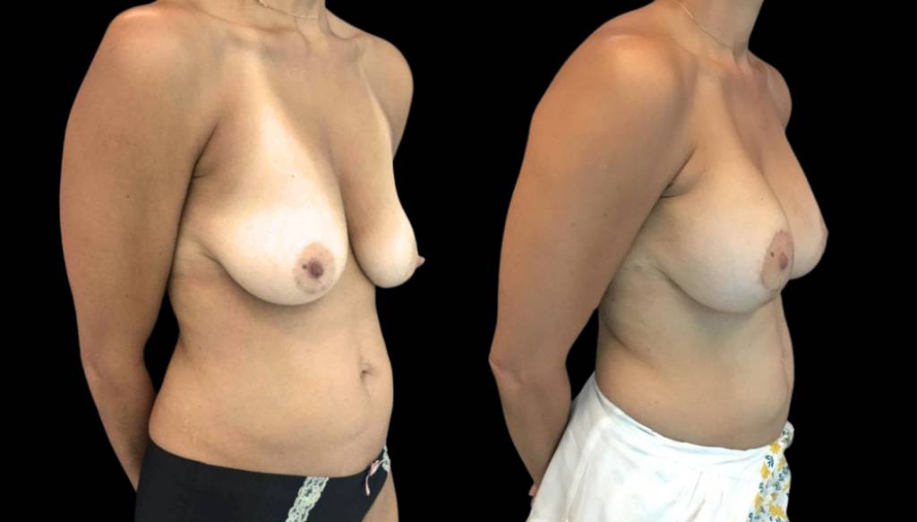 48-year-old-female-breast-lift-with-augmentation-before-and-after-three-quarter-view.jpg