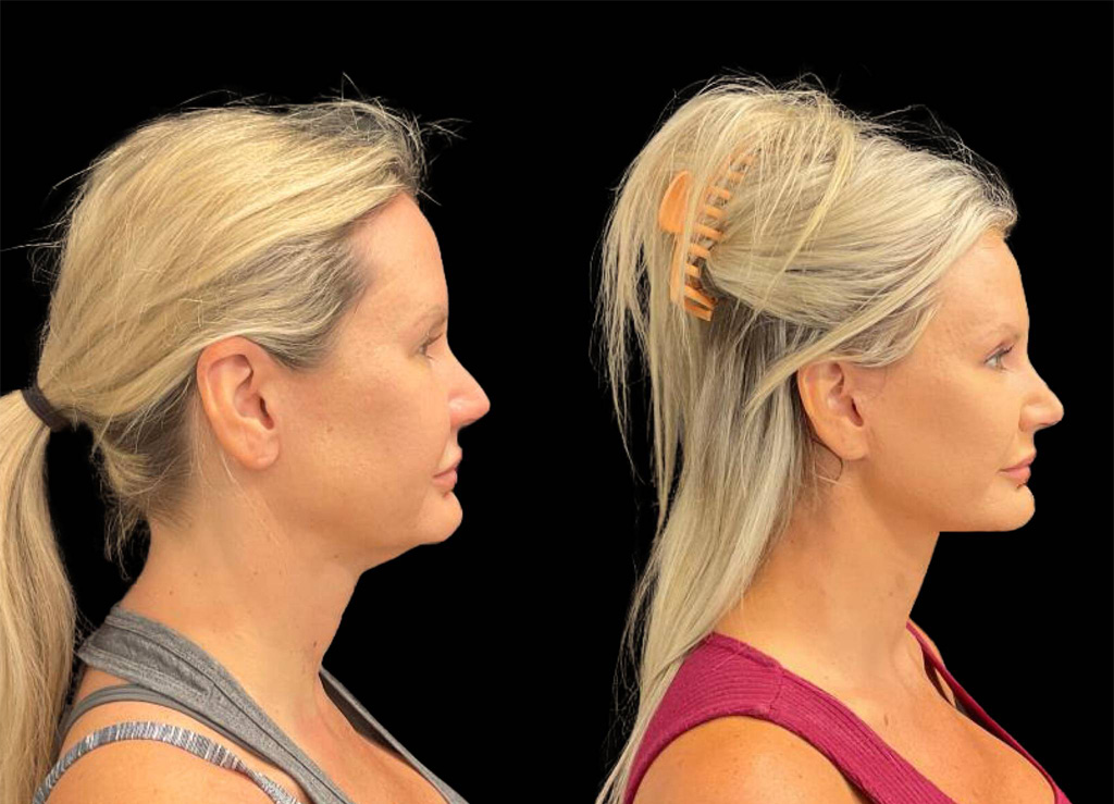 48-year-old-female-facelift-before-and-after-1.jpg