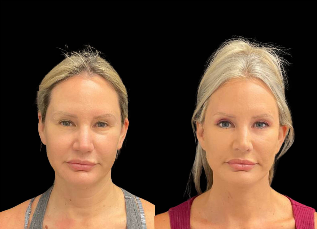 48-year-old-female-facelift-before-and-after.jpg