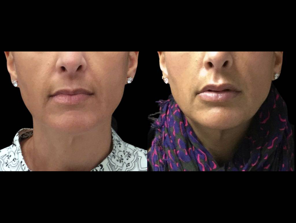 48-year-old-female-lip-augmentation-before-and-after.jpg