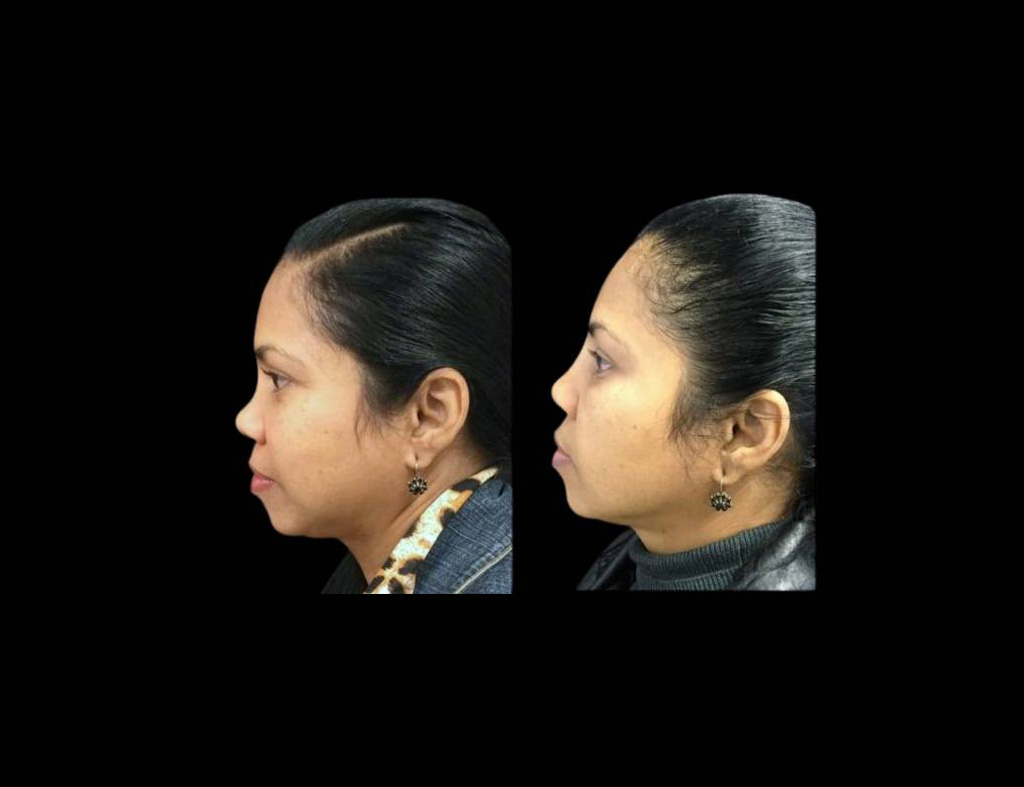 48-year-old-female-non-surgical-rhinoplasty-side-view.jpg