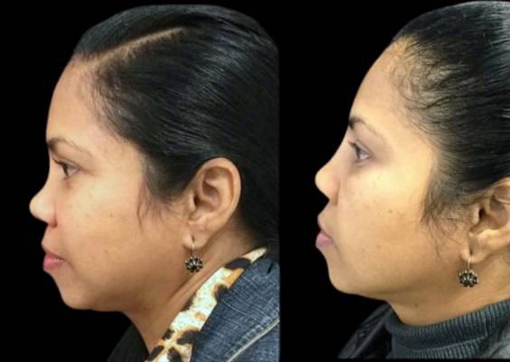 48-year-old-female-non-surgical-rhinoplasty-side-view.jpg