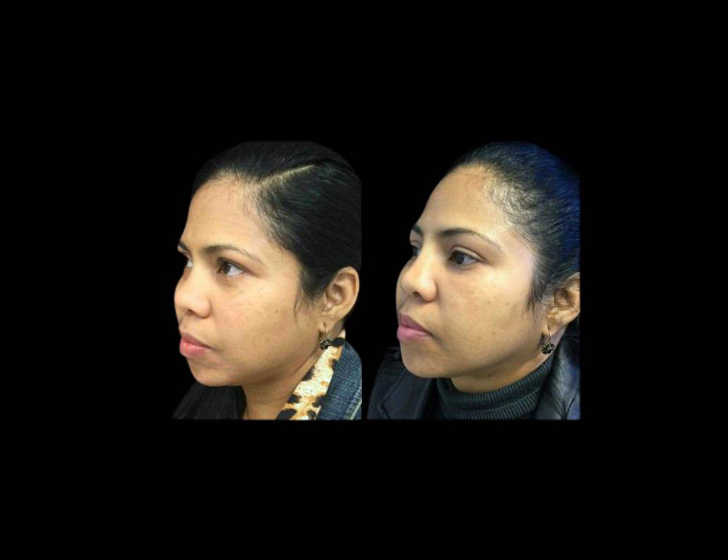 48-year-old-female-non-surgical-rhinoplasty-three-quarters-view.jpg