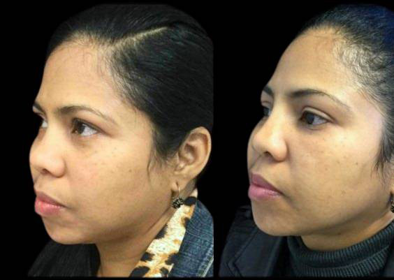 48-year-old-female-non-surgical-rhinoplasty-three-quarters-view.jpg