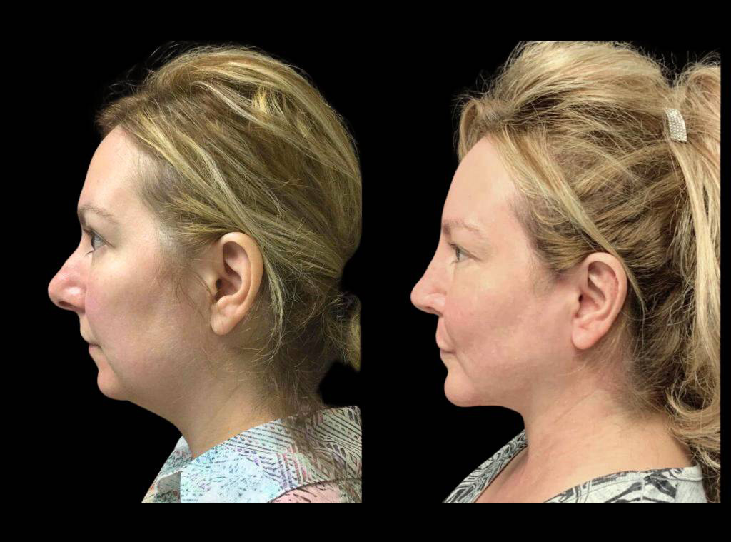 48-year-old-female-rhinoplasty-before-and-after-side-view-2.jpg