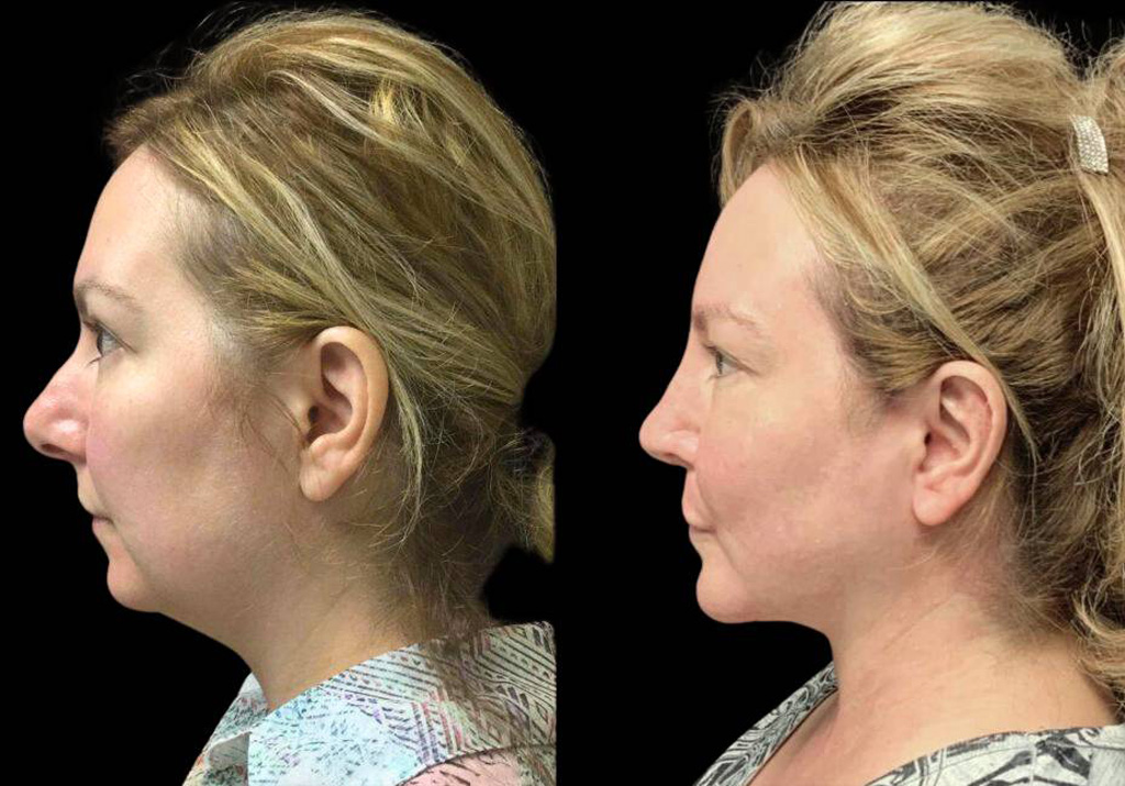 48-year-old-female-rhinoplasty-before-and-after-side-view-2.jpg