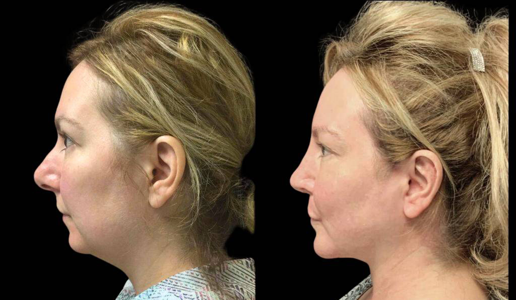 48-year-old-female-rhinoplasty-before-and-after-side-view-2.jpg