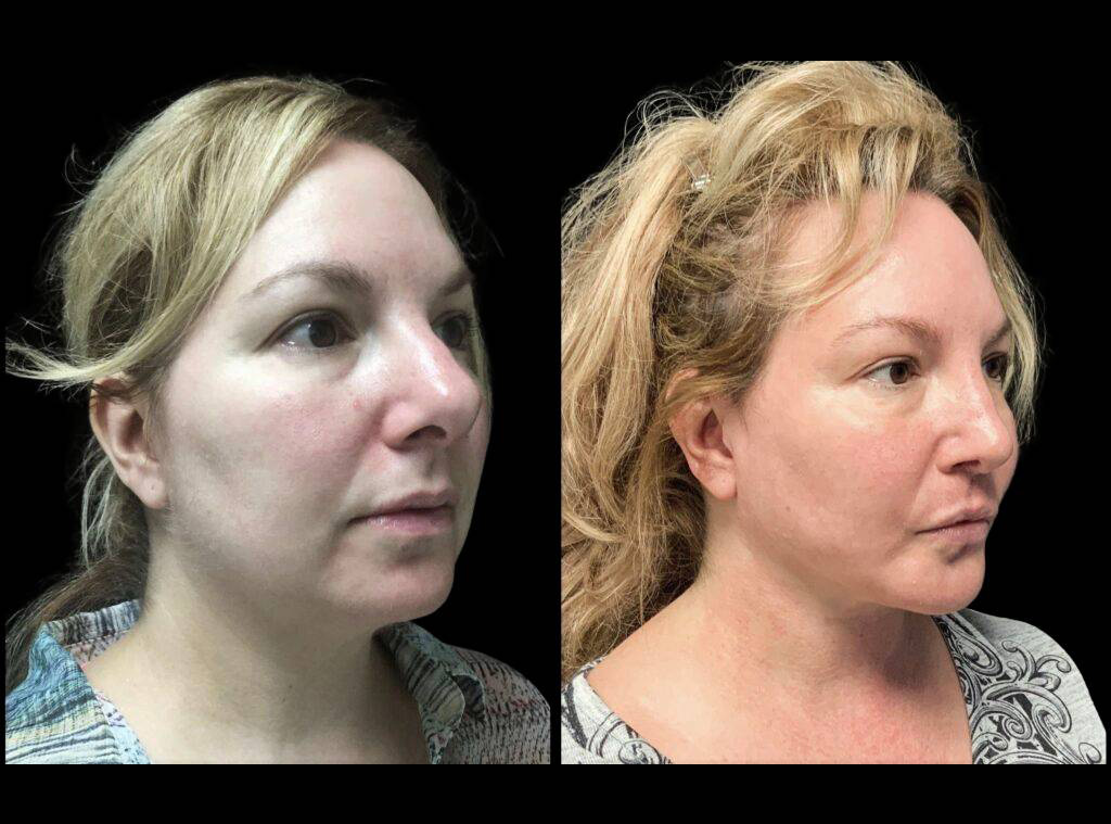48-year-old-female-rhinoplasty-before-and-after-three-quarters-view.jpg