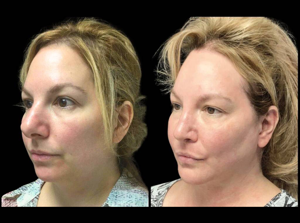 48-year-old-female-rhinoplasty-before-and-after-three-quarters-view-2.jpg