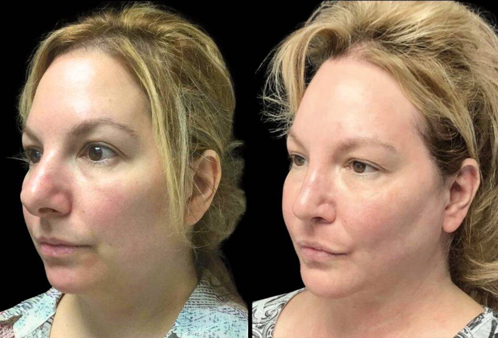 48-year-old-female-rhinoplasty-before-and-after-three-quarters-view-2.jpg