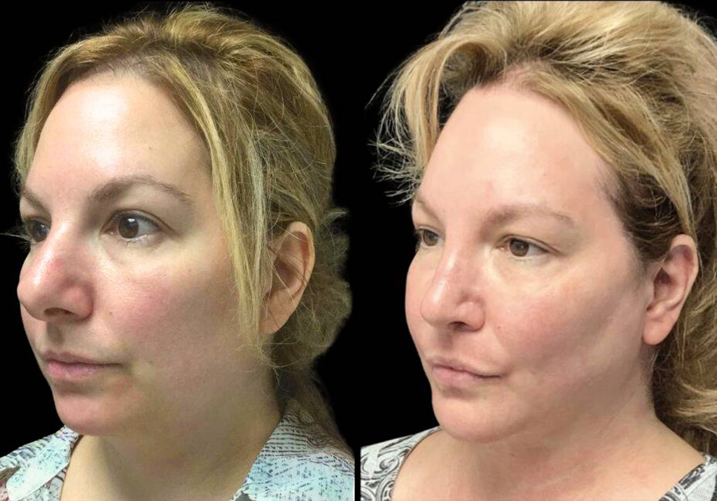 48-year-old-female-rhinoplasty-before-and-after-three-quarters-view-2.jpg