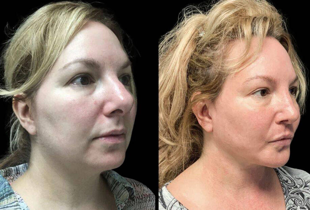 48-year-old-female-rhinoplasty-before-and-after-three-quarters-view.jpg