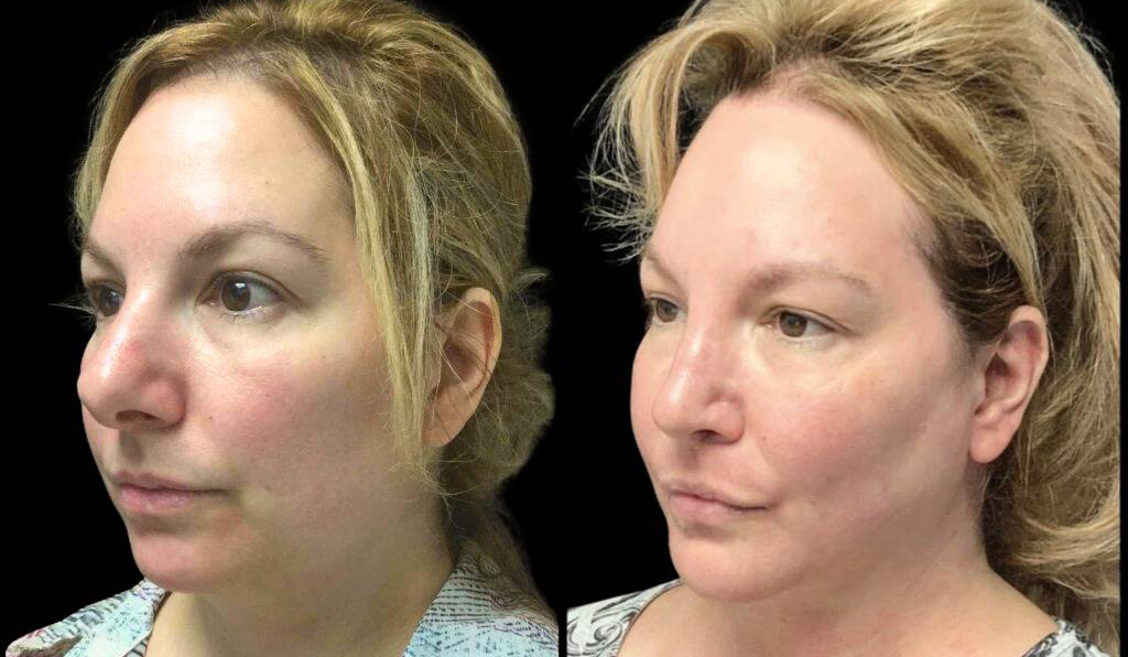 48-year-old-female-rhinoplasty-before-and-after-three-quarters-view-2.jpg