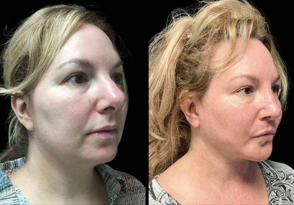 48-year-old-female-rhinoplasty-before-and-after-three-quarters-view.jpg