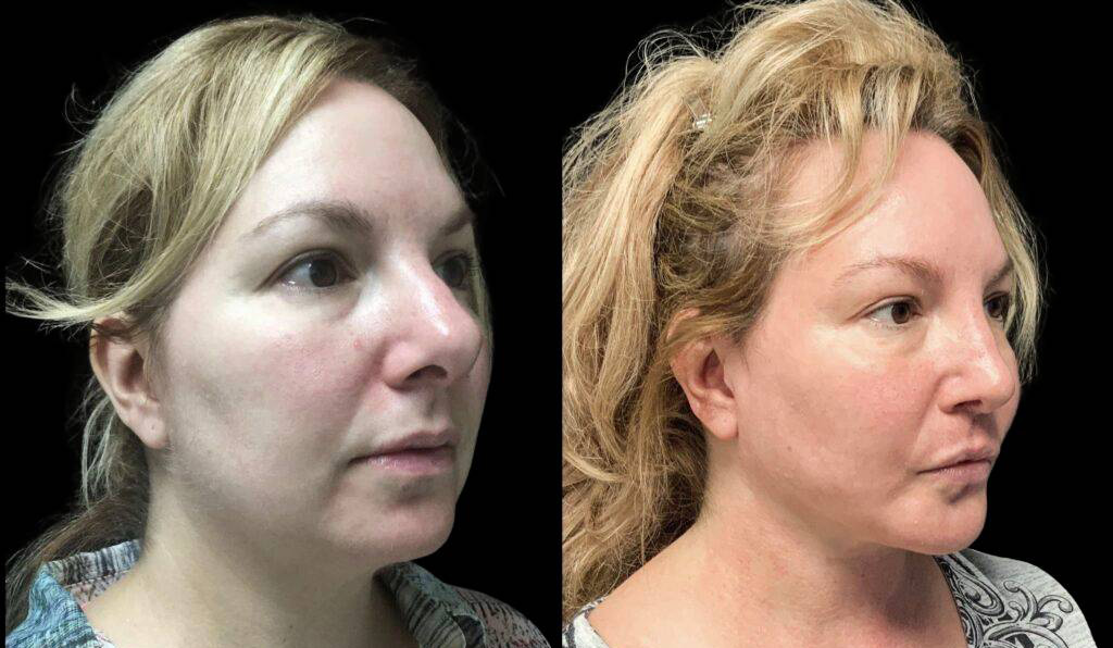 48-year-old-female-rhinoplasty-before-and-after-three-quarters-view.jpg