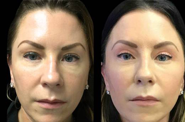 48-year-old-female-upper-and-lower-eyelid-lift-before-and-after-front-view-6903.jpg