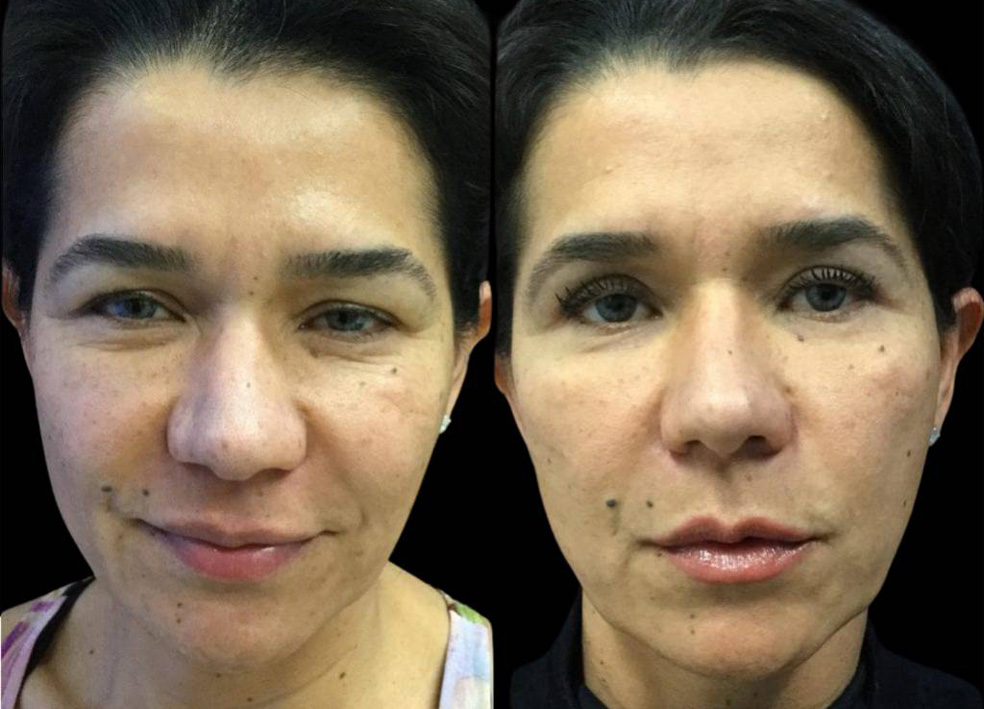 48-year-old-female-upper-eyelid-lift-before-and-after-front-view-21567.jpg