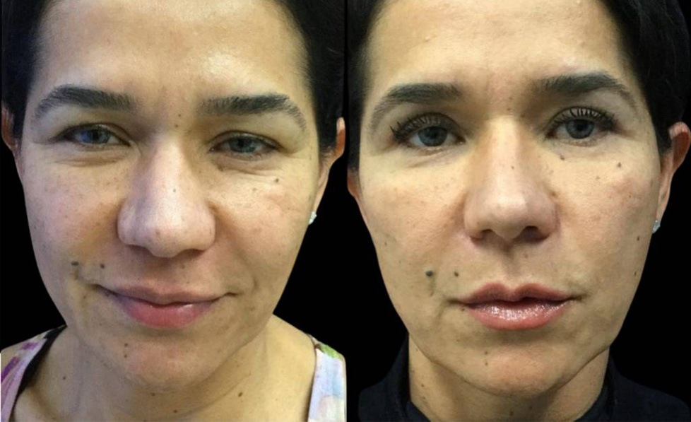 48-year-old-female-upper-eyelid-lift-before-and-after-front-view-21567.jpg