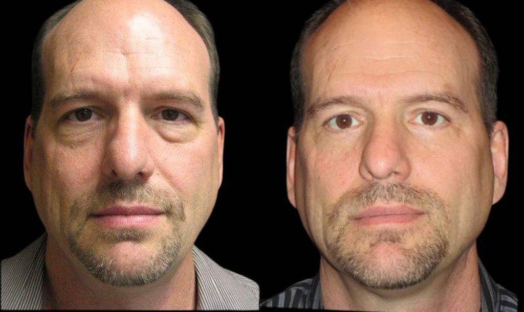 48-year-old-male-lower-eyelid-lift-before-and-after-front-view-.jpg