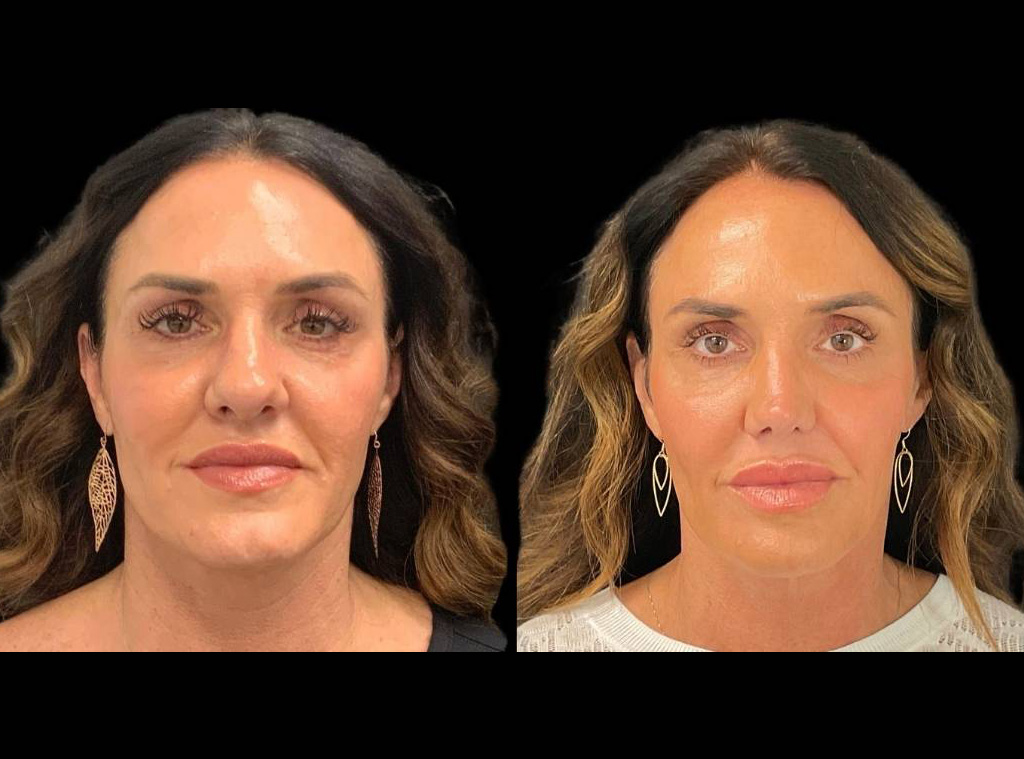 48-yr-old-female-rhinoplasty-before-and-after-front-view.jpg