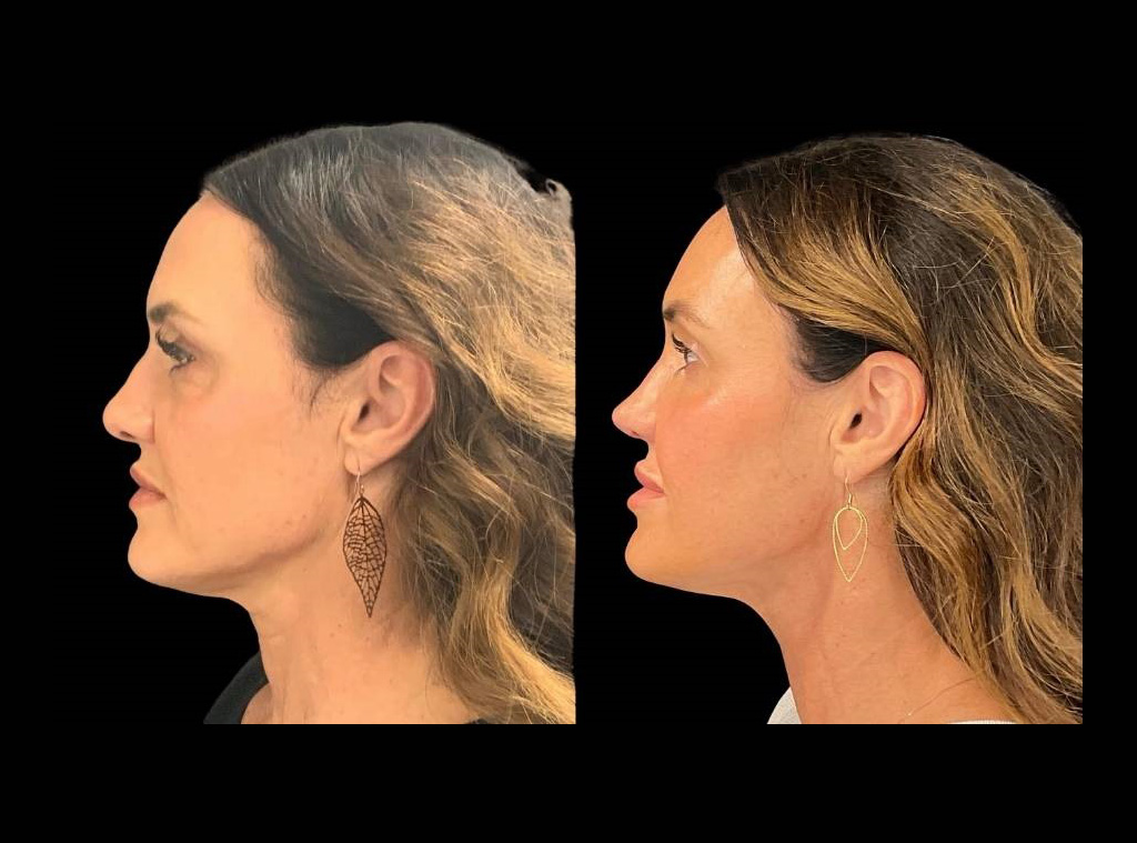 48-yr-old-female-rhinoplasty-before-and-after-left-view.jpg