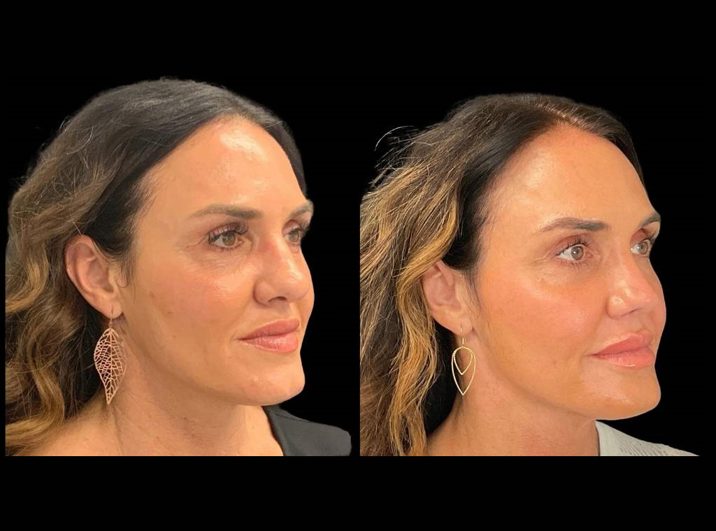 48-yr-old-female-rhinoplasty-before-and-after-right-three-quarter-view.jpg