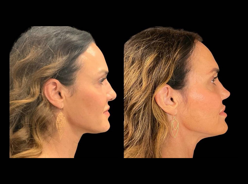 48-yr-old-female-rhinoplasty-before-and-after-right-view.jpg
