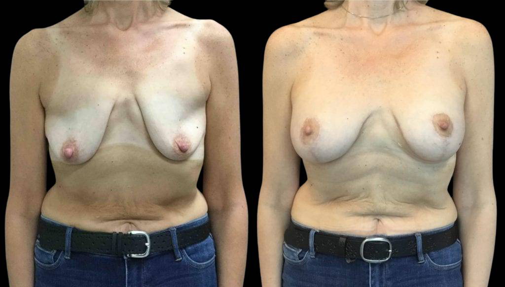 49-year-old-female-breast-lift-with-augmentation-before-and-after-front-view.jpg