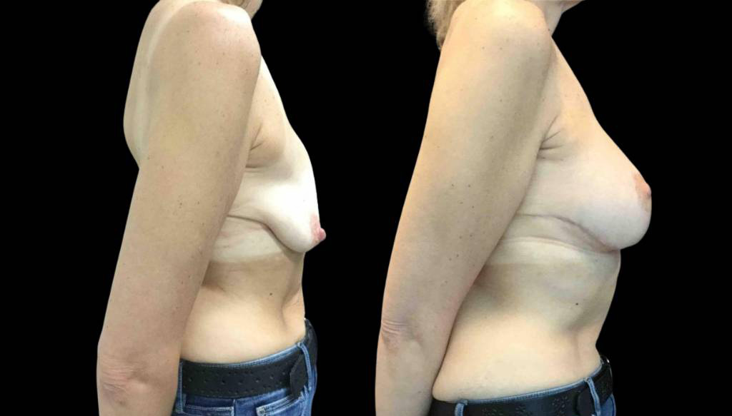 49-year-old-female-breast-lift-with-augmentation-before-and-after-side-view.jpg