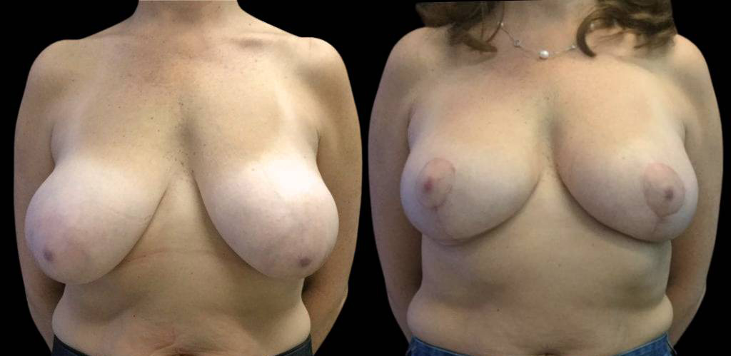 49-year-old-female-breast-reduction-before-and-after-front-view.jpg