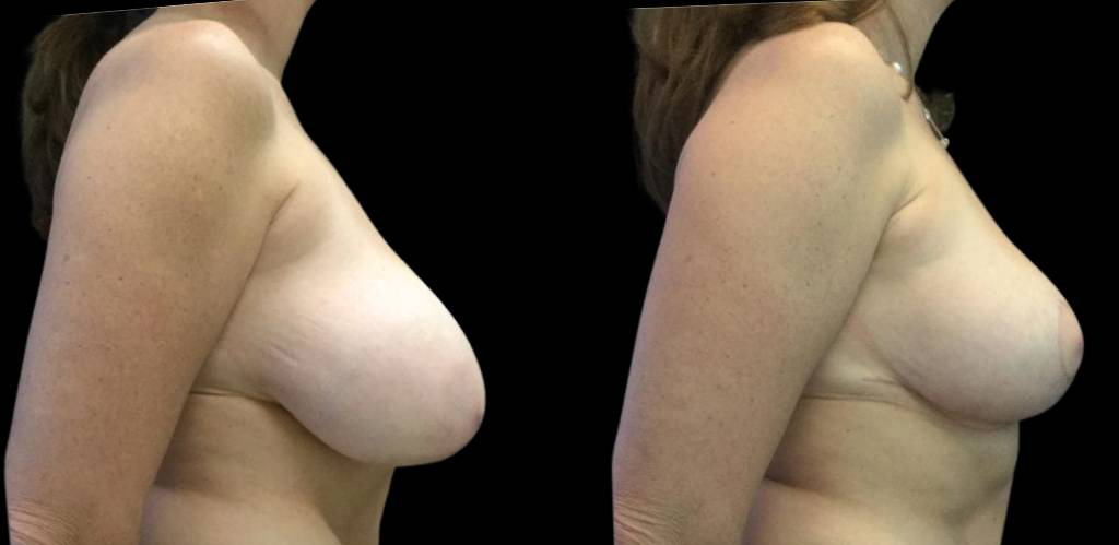 49-year-old-female-breast-reduction-before-and-after-side-view.jpg