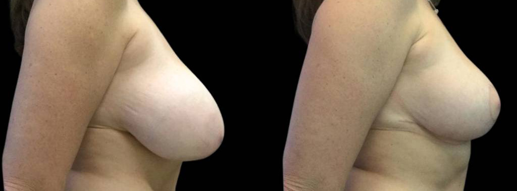 This is a 49-year-old female that has had a breast reduction showing the before and after's side-by-side