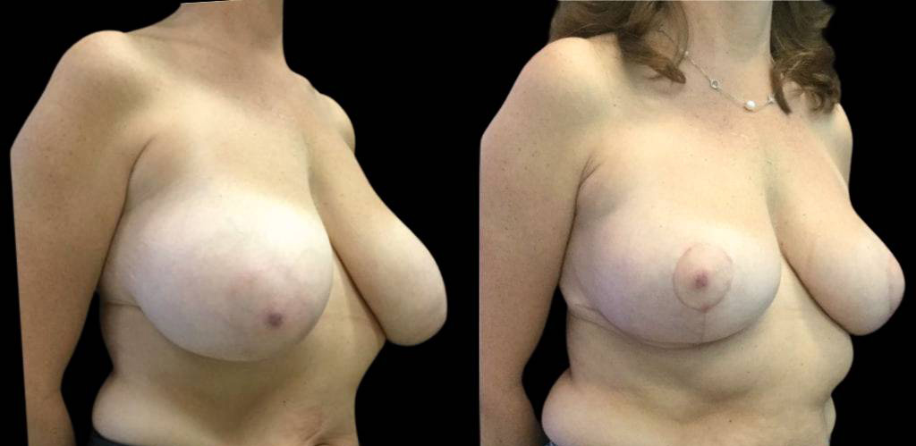 49-year-old-female-breast-reduction-before-and-after-three-quarter-view.jpg