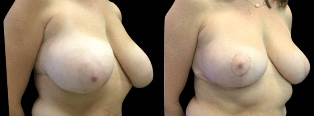 This is a 49-year-old female that has had a breast reduction showing the before and after's side-by-side