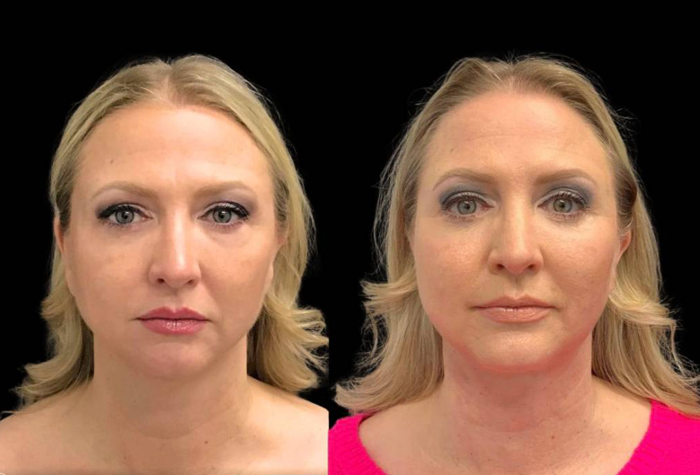 49-year-old-female-chin-implant-before-and-after-front-view-33886.jpg