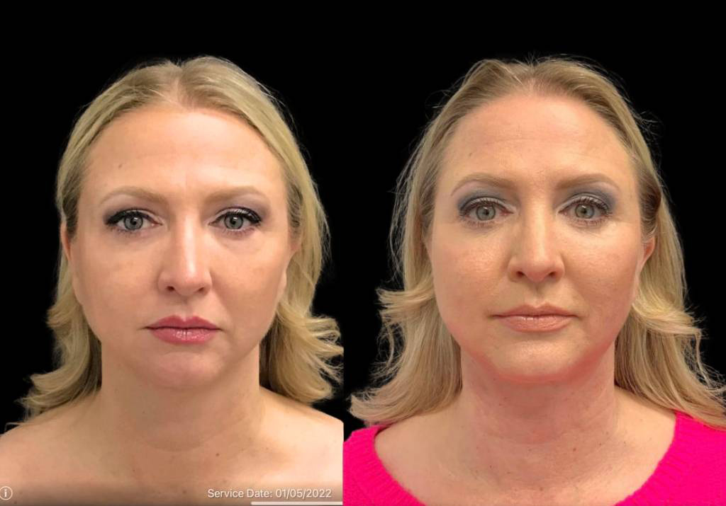 49-year-old-female-chin-implant-before-and-after-front-view-33886.jpg