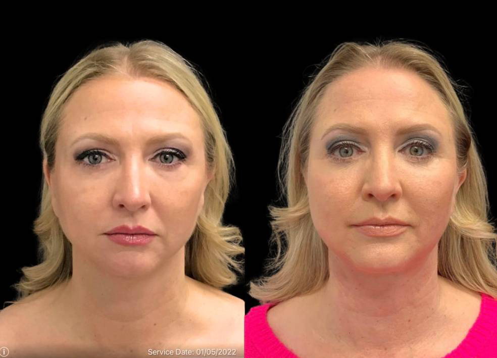 49-year-old-female-chin-implant-before-and-after-front-view-33886.jpg