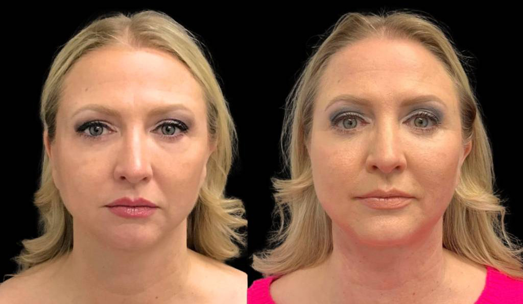 49-year-old-female-chin-implant-before-and-after-front-view-33886.jpg