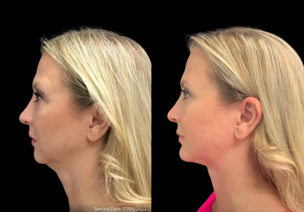 49-year-old-female-chin-implant-before-and-after-side-view-2.jpg