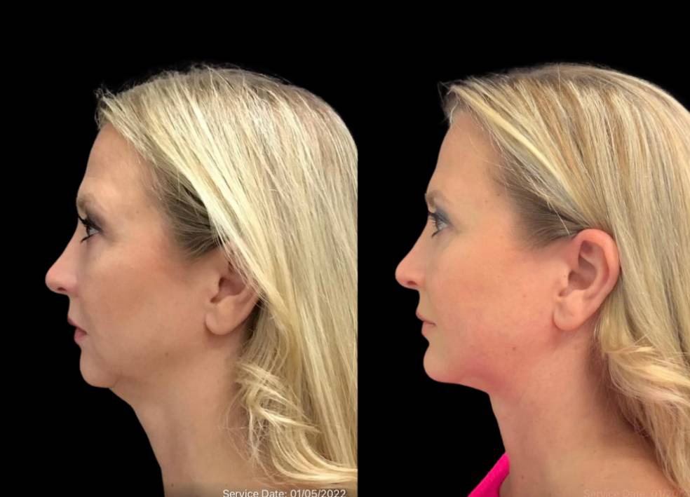 49-year-old-female-chin-implant-before-and-after-side-view-2.jpg