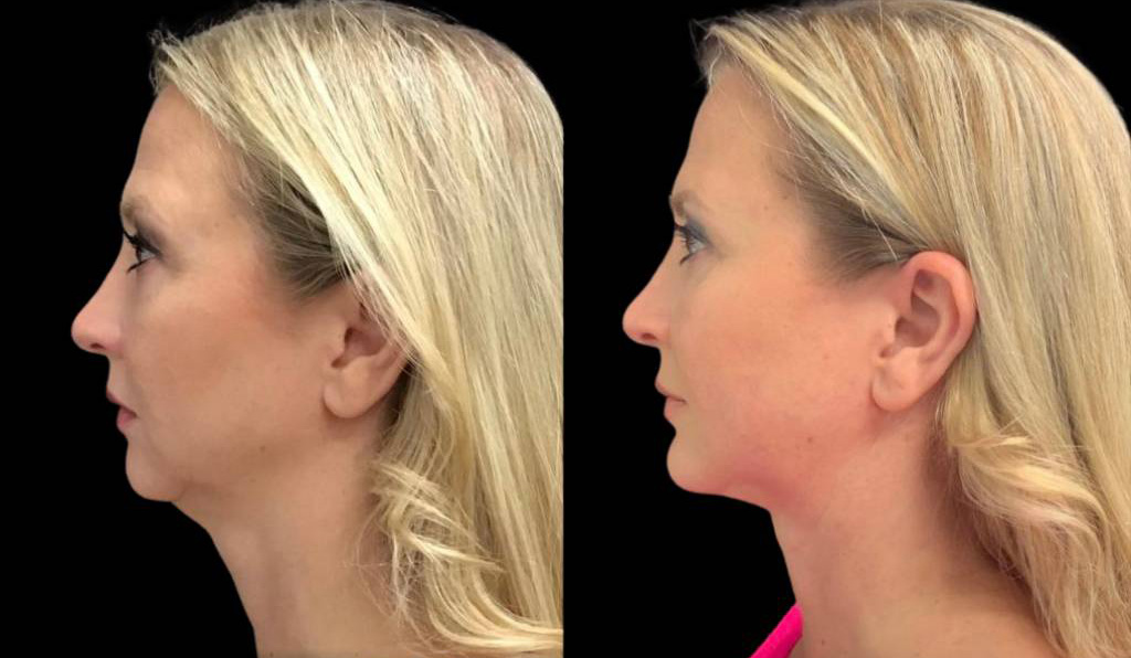 49-year-old-female-chin-implant-before-and-after-side-view-2.jpg