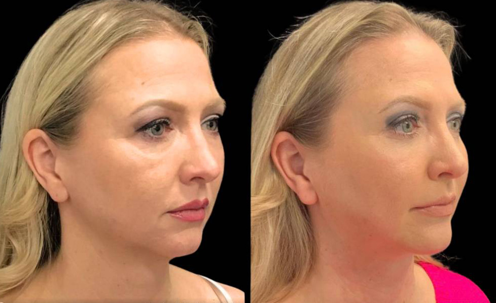 49-year-old-female-chin-implant-before-and-after-three-quarter-view.jpg
