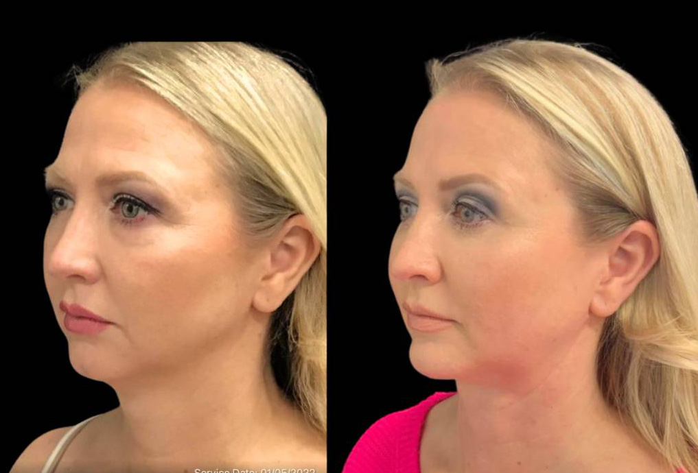 49-year-old-female-chin-implant-before-and-after-three-quarter-view-2.jpg